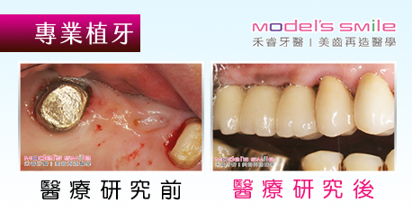 【台北牙醫無痛植牙案例】吃大餐牙斷疼痛難耐 補骨植牙還正常飲食